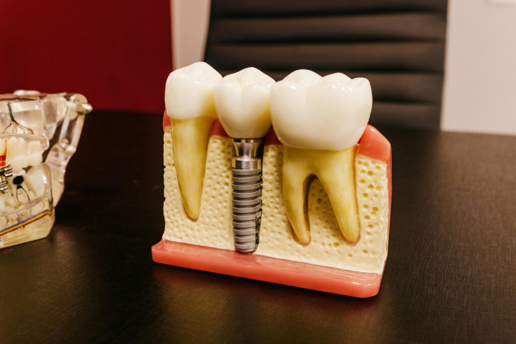 Ceramic dental implants with bolt in artificial mouth piece on desktop in hospital